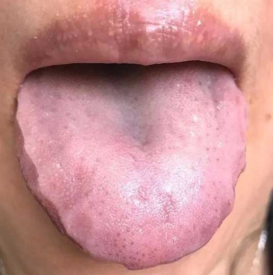 《中医舌诊》九大体质舌诊图(图8)