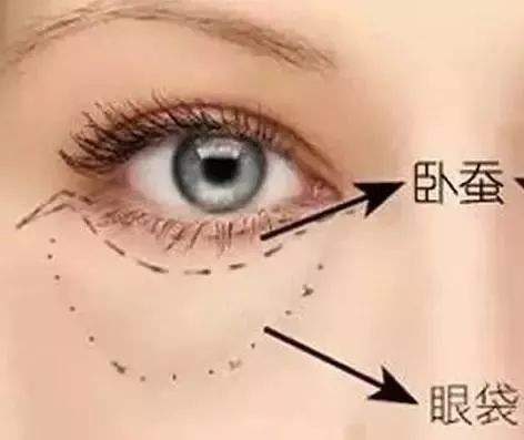 祛眼袋黑眼圈妙方，坚持三天后有奇效