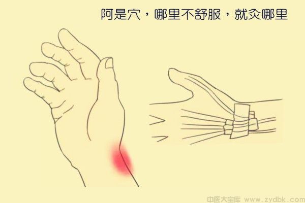 阿是穴