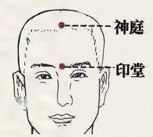 神庭穴(图1)