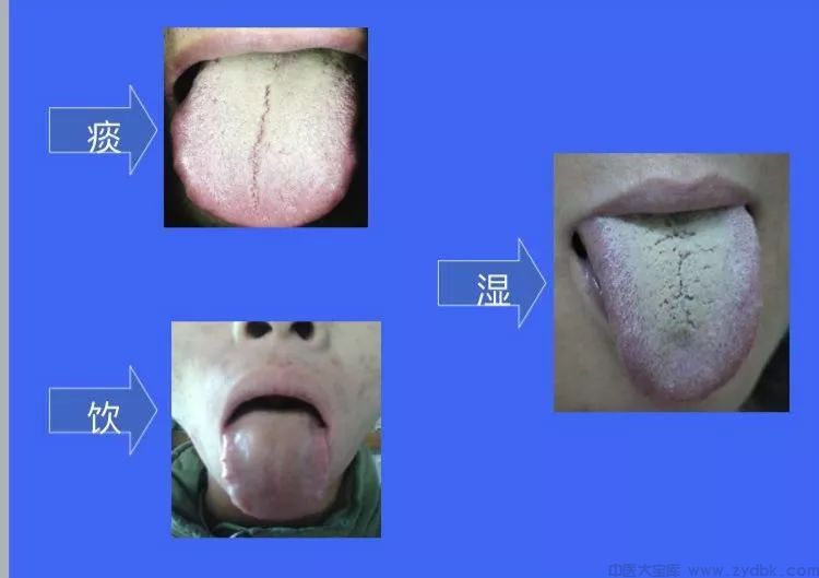 伤寒论和金匮里的神效五苓散