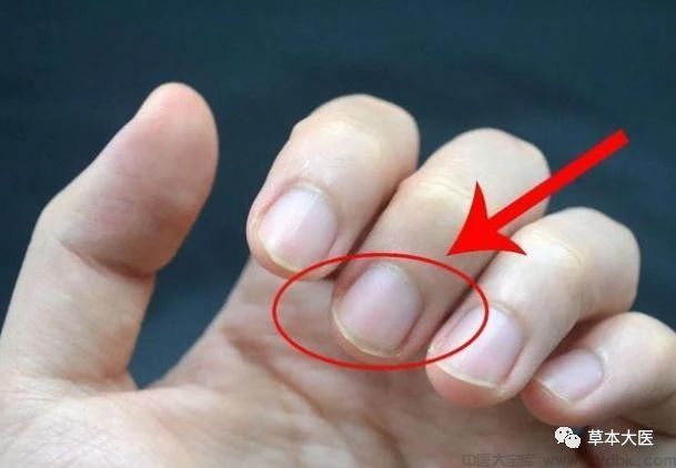 指甲无月牙的中医辨证和中药方剂、食疗方