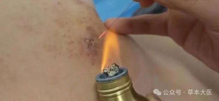 火针和中药调理癌症肿瘤疼痛案例(图1)